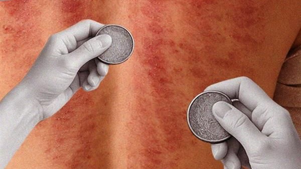 Coining Rash Can rubbing a coin on your skin help you kick a cold? - The Nod Mag